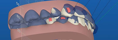 Invisalign - passo 3