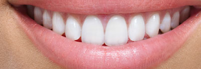 Invisalign - passo 5